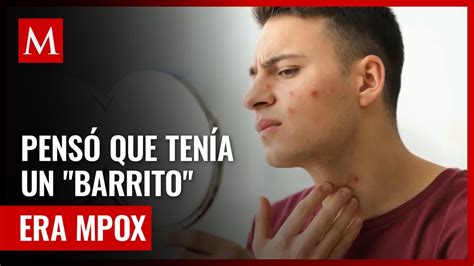 Hombre Confunde Virus De Mpox Con Un Barrito En El Rostro YouTube