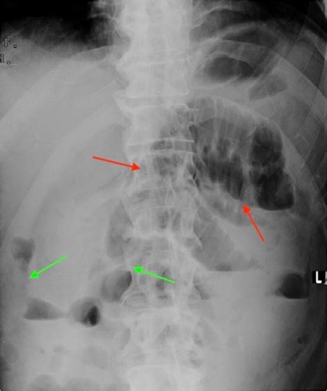 Figure 1 Erect Plain Abdominal X Ray On Admission Confirming Acute