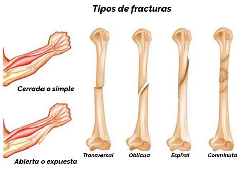 Signos De Fractura De Hueso