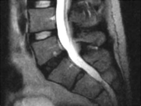 Degenerative Disc Disease Ddd Symptoms Treating Dr Nesterenko