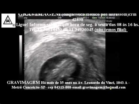 Gravimagem Ultrassom Morfol Gico Em Gravidez Semanas Youtube