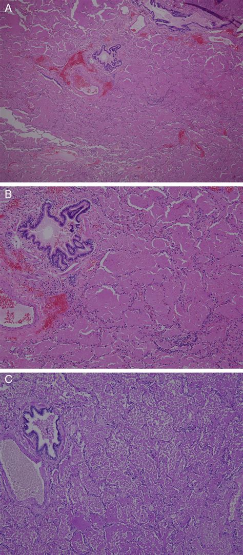 Under microscopy, the alveolar architectures appeared well preserved ...