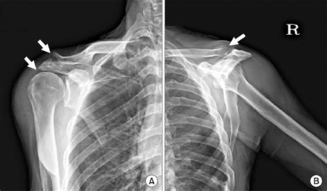 Acromioclavicular joint osteoarthritis – Caring Medical