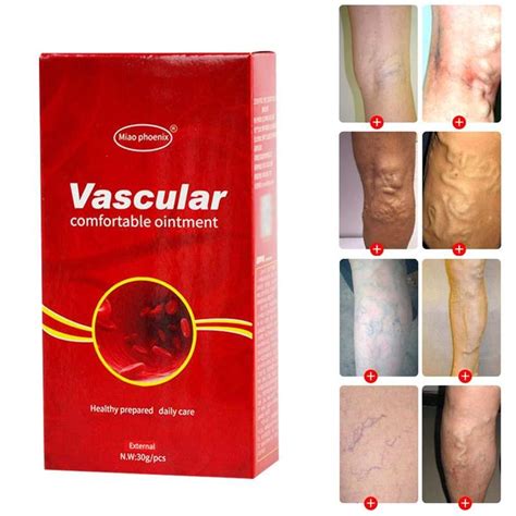 Spider Veins Pain Varicosity Removal Effective Cream