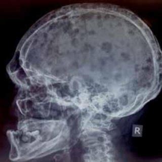 Multiple Punched Out Osteolytic Lesions On The Lateral Skull Radiograph