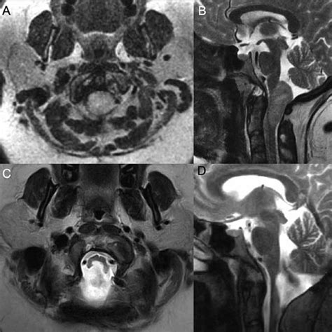 Preoperative Axial A And Sagittal B T2 Mri Demonstrate A Download Scientific Diagram