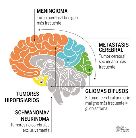 Tumores Cerebrales Cancer Sintomas Y Tratamiento Nbkomputer