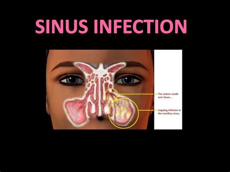 Ppt Sinus Infection Powerpoint Presentation Free Download Id3136525