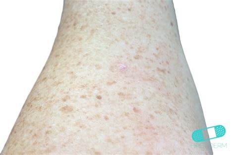 Online Dermatology Actinic Keratosis Ak