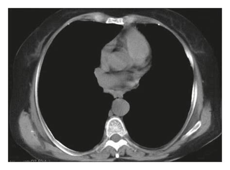 MRI Images For PB Patients A MRI Image Of A 7 Year Old Male Patient