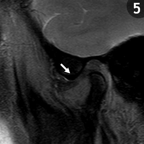 Anterior Disc Displacement Without Reduction Left Tmj Sagittal Plane