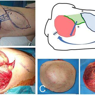 A Bilateral Reverse Myocutaneous Latissimus Dorsi Flap Measuring Cm