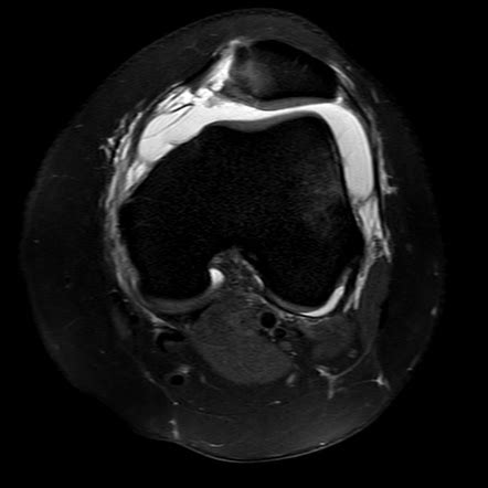 Medial Patellofemoral Ligament