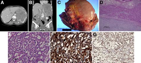 Peritoneal Mesothelioma Pubmed 2022E Jurnal