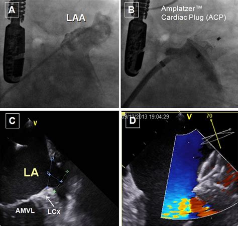 Left Atrial Appendage Anatomy And Imaging Landmarks Pertinent To