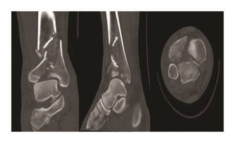 The Patients Preoperative Radiological Characteristics Of Pilon