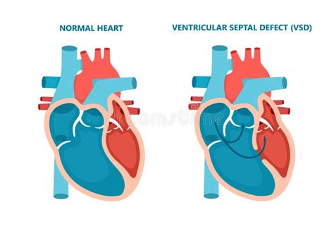 Anatomía Cardíaca Humana Con Flujo Sanguíneo Circulación De Sangre A