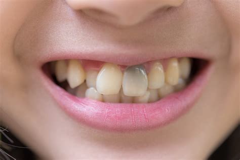 Causes Des Taches Marron Ou Brunes Sur Les Dents Et Les Solutions