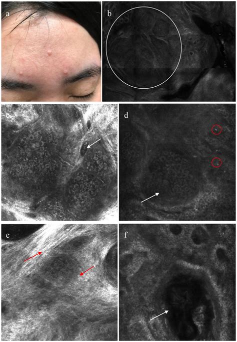 Patient with sebaceous gland hyperplasia (SGH) on the face (a ...