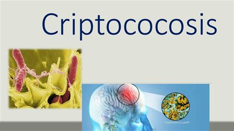 Resúmenes de Criptococosis meníngea Descarga apuntes de Criptococosis