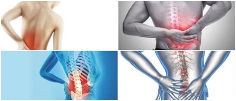 Dolor Lumbar Tipos Causas Síntomas Diagnóstico Tratamientos Y