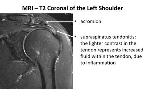 Fig 6 B Mri Ss Tendonitis Cambridge Shoulder