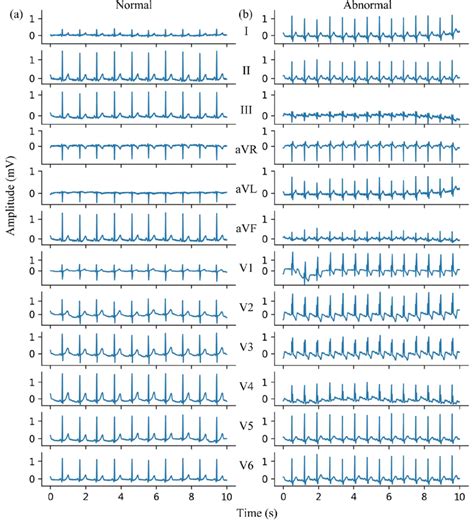 (a) Normal ECG sample and (b) abnormal ECG sample in preliminary ...