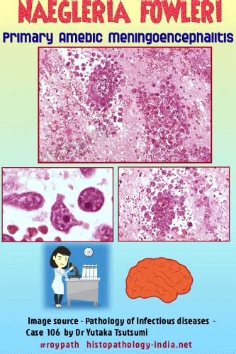 Pathology Of Primary Amebic Meningoencephalitis Naegleriasis Dr Sampurna Roy Md