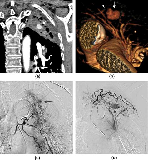 Bronchial Embolisation For Infected Pulmonary Artery Pseudoaneurysms Causing Haemoptysis