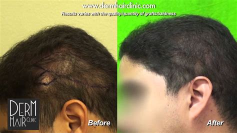 Fue Hair Transplant Repair And Body Hair Transplant Strip Scar And Shock Loss Repair Youtube