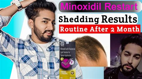 Minoxidil Restart After 2 Month Condition YouTube