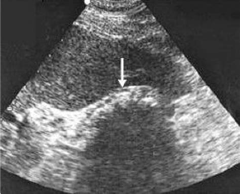 Figure 1 From Gallbladder Agenesis A Case Report And Review Of The Literature Semantic Scholar