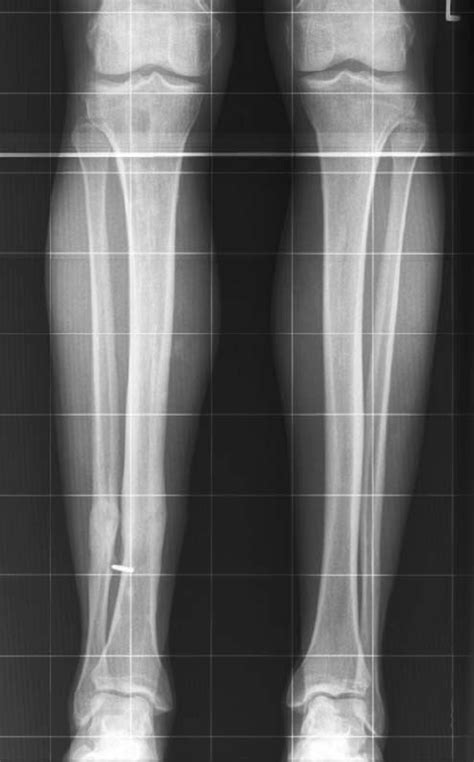 A 38-year-old man sustained a closed distal tibial metaphyseal fracture... | Download Scientific ...