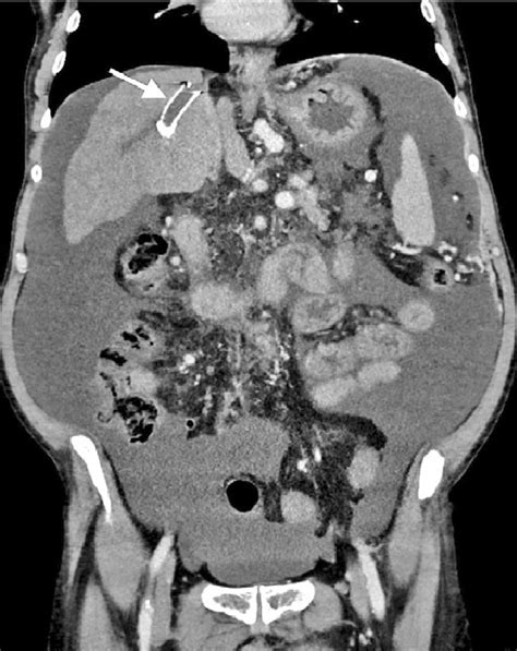 The Abdominal Contrast Enhanced Ct Scan Venous Phase Reveals Complete