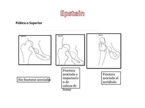 Luxación De Cadera Ppt