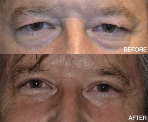 What To Expect From A Blepharoplasty Before And After Envision Aesthetics