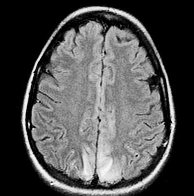 S Ndrome Da Leucoencefalopatia Posterior