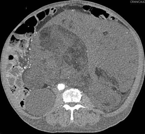 Large Retroperitoneal Liposarcoma Gastrointestinal Case Studies