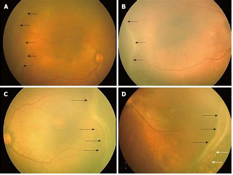 Retcam Fundus Images Showing Retinopathy Of Prematurity Stages 1 2 3