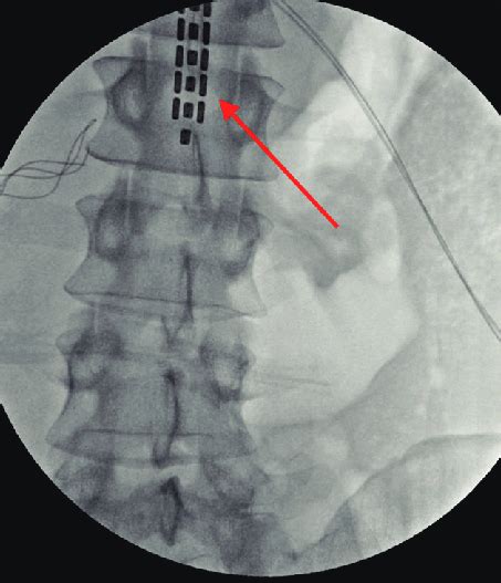 Intraoperative X Ray Following Epidural Spinal Cord Stimulation Download Scientific Diagram