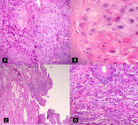 A Well Differentiated Squamous Cell Carcinoma In Gallbladder Neck Download Scientific Diagram