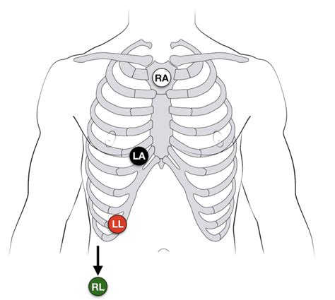 emDOCs.net – Emergency Medicine EducationECG Pointers – The Lewis Lead - emDOCs.net - Emergency ...