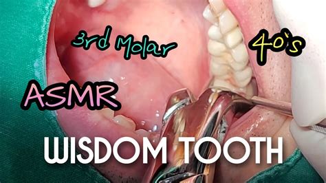 ASMR Wisdom Tooth Extraction In 40 Seconds YouTube