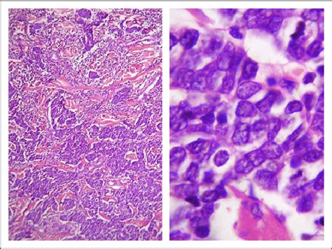 Merkel Cell Carcinoma Histology