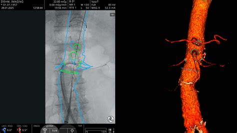 RSNA 2025: Ziehm Imaging presents innovative mobile C-arm technologies