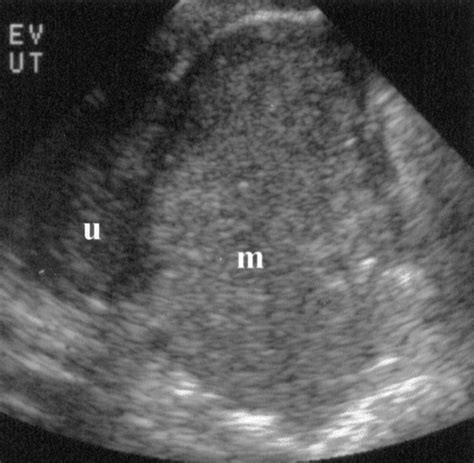 Imaging Evaluation Of Ovarian Masses Radiographics