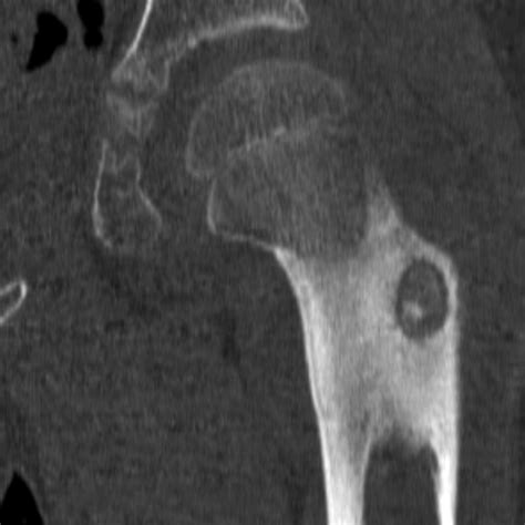 Osteoid Osteoma Image