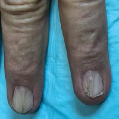 Nail Patella Syndrome Clinical Clues For Making The Diagnosis Mdedge