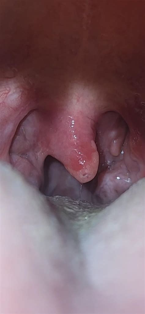 Swollen Uvula Getting Worse After Week No Other Symptoms R