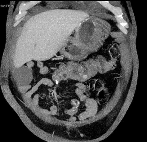 Diverticulum Transverse Colon Colon Case Studies Ctisus Ct Scanning